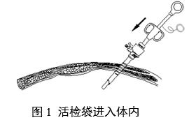 一次性使用內(nèi)窺鏡用活檢袋注冊(cè)審查指導(dǎo)原則（2025年第20號(hào)）(圖1)